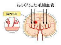 s_脳内出血