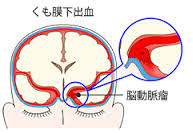 s_くも膜下出血