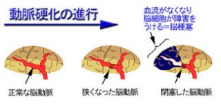 s_脳梗塞