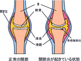 s_関節炎