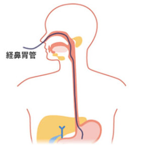 経鼻栄養01