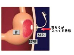 胃ろう