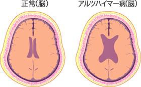認知症の脳