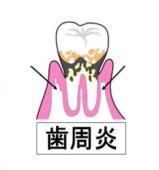 歯周炎